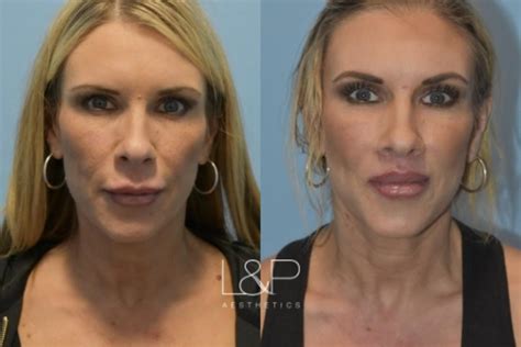 Lip Lift Procedure Before And After | Sitelip.org