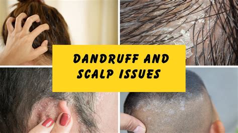 The Ultimate Guide to Dealing with Dandruff: Causes and Cures | #haircare #haircaretips - YouTube