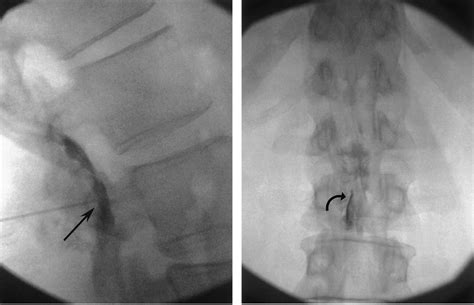 REVIEW ARTICLE – Epidurography – Anaesthesia, Pain & Intensive Care