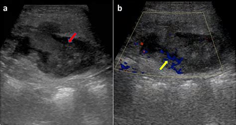 Rare Case of Primary Anterior Abdominal Wall Abscess: Ultrasound, CT ...