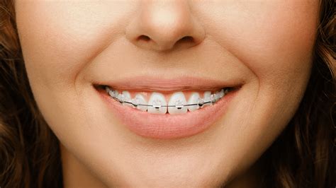 Are you interested in invisible braces for adults? If so, you have the ...