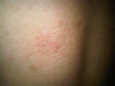 2 days ago i found a red circular a bit itchy spot on my stomach