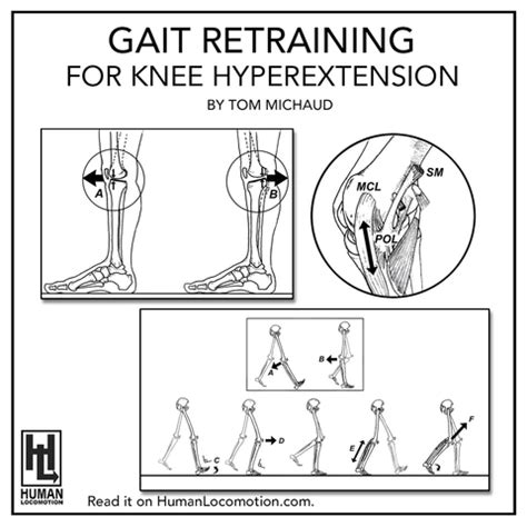 Gait Retraining for Knee Hyperextension - Human Locomotion