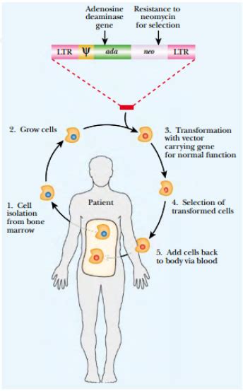 Retrovirus Gene Therapy for SCID - Study Solutions