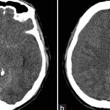 (a) Immediate postoperative CT scan after bilateral burr hole drainage ...