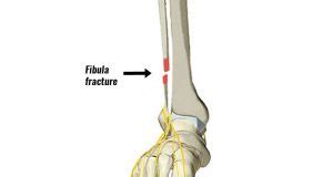 Fibula Fracture - Types, Symptoms, Causes and Rehabilitation