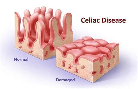 Resources and Information on Celiac Disease | Elana's Pantry