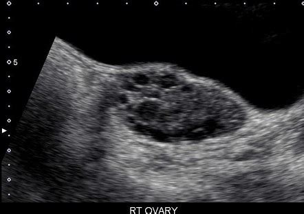 Normal Vs Polycystic Ovaries Ultrasound