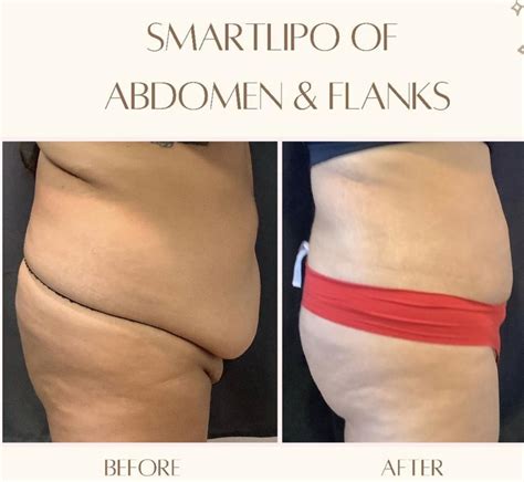 Laser Liposuction for 2022 with SmartLipo Triplex | Just Medical Care