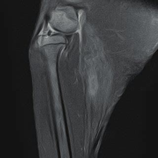 MRI of the right gastrocnemius muscle. (A) hypersignal changes and... | Download Scientific Diagram