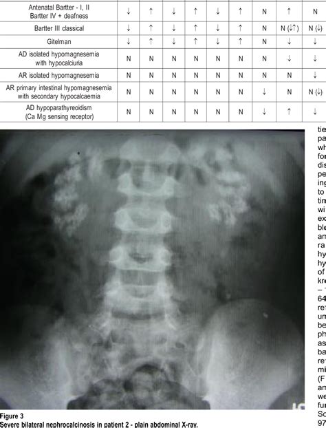 Figure 3 from Familial hypomagnesemia with hypercalciuria and nephrocalcinosis case reports and ...