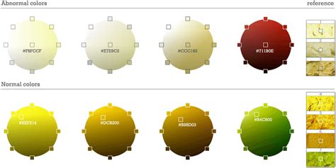 neonatal cholestasis an update medcrave online - biliary disease stool color stools item | stool ...