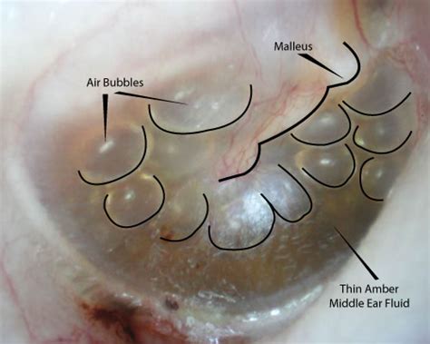 Fluid in the ear Images | McGovern Medical School