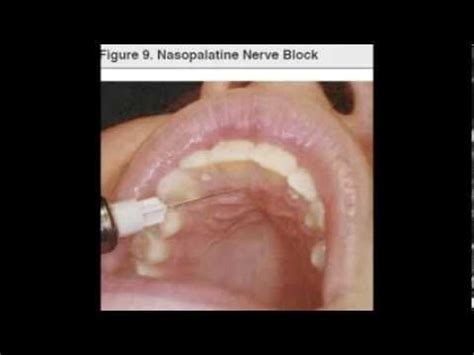 NP nasopalatine nerve block - YouTube