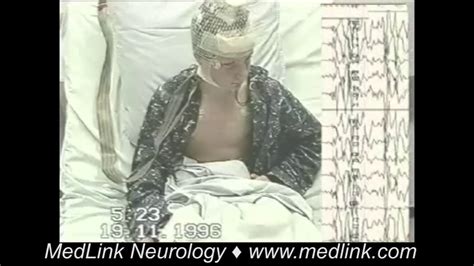 Myoclonic Seizures | MedLink Neurology