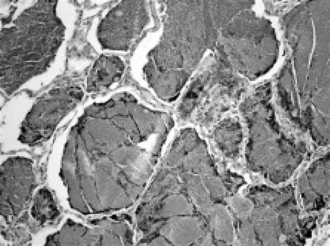 Autoimmunological pulmonary alveolar proteinosis. Finely granular ...