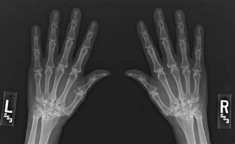 Rheumatoid Arthritis X Ray Neck