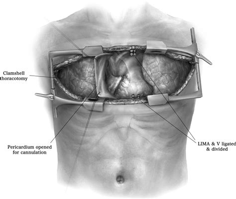 Bilateral Lung Transplantation - Operative Techniques in Thoracic and Cardiovascular Surgery