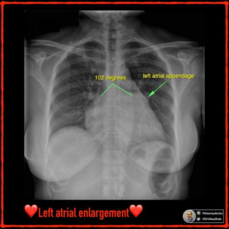 The xray doctor - ️💙💚💛💜 The signs of 📝left atrial...