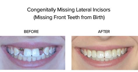 Congenitally Missing Lateral Incisors | Mint Hill Dentistry | Dentist ...