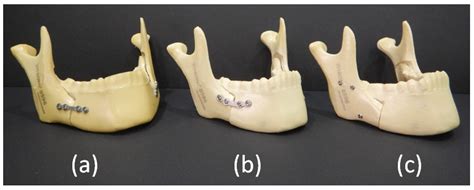 Gufo Hubert Hudson consonante inverted l osteotomy mandible Finora turista Grande universo