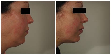 chin lipo before and after (1) | Laser Lipo