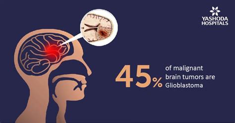 Glioma: Causes, Symptoms, Diagnosis and Treatment