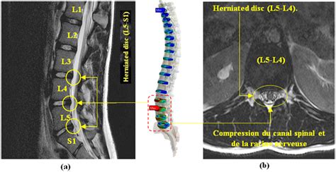 Figure 27. Sagittal section a lumbosacral MRI T2 showing disc degeneration (disc disease) at the ...