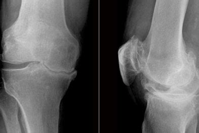 Osteoarthritis - Clinical review | GPonline