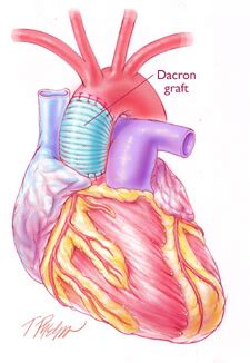 Aortic Aneurysm Surgery