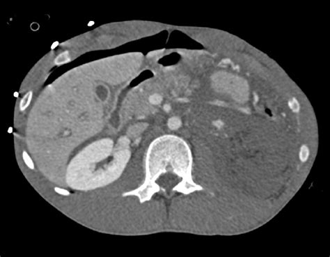 Devascularized left kidney with pooling of extravasated contrast at the ...