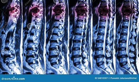 MRI Of Lumbar & Thoracic Spine : Show Fracture Of Thoracic Spine And Compress Spinal Cord ...