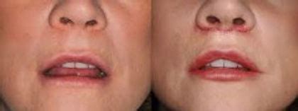 How your philtrum gives your age away……