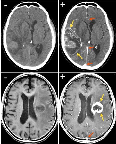 Diagnosis of Brain Aneurysms | Medtalk