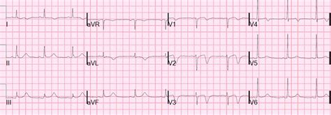 Dr. Smith's ECG Blog: Wellens' syndrome, no culprit, what happened?