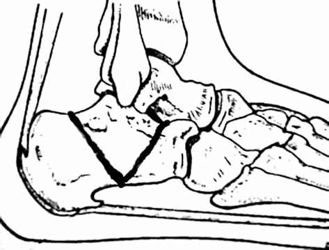 -Schematic drawing of osteotomy end at the subtalar joint. | Download Scientific Diagram