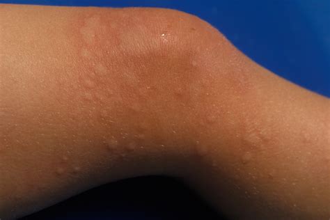 Rashes in babies and children - NHS