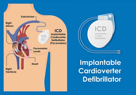 Implantable Cardiac Defibrillator – Australian Cardiovascular Specialists