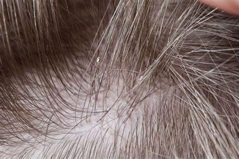 Close up of head lice egg. | About Nits-Lice eggs | Pinterest | Lice eggs, Eggs and Close up
