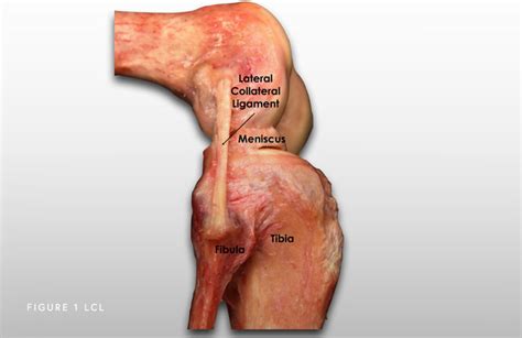 Lateral Collateral Ligament (LCL) Tear Chicago, IL - Jorge Chahla, MD