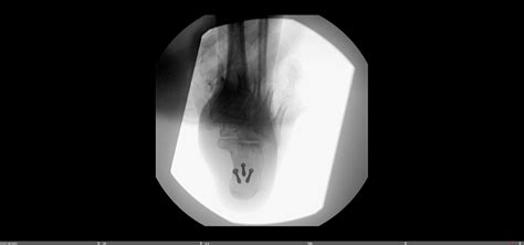 Tongue Type Calcaneus Fracture — Chicago Foot & Ankle Orthopaedic Surgeons