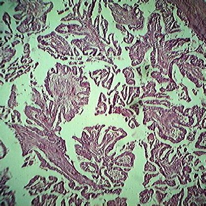 Gross appearance of mastectomy specimen with a tumor on serial cut... | Download Scientific Diagram