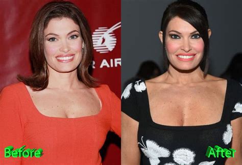 Kimberly Guilfoyle Plastic Surgery: A New Youth For News Anchor