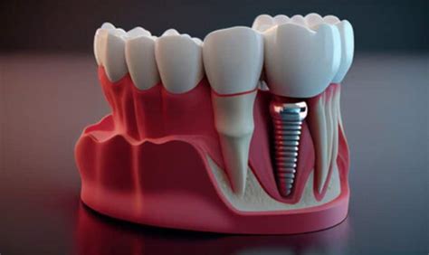 Choosing Between Titanium and Zirconia Dental Implants