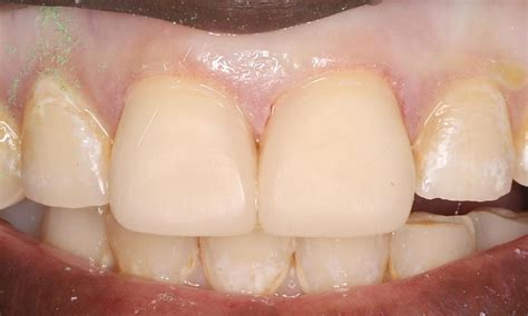 Humble Dentistry's Smile Gallery | Direct Composite Veneers