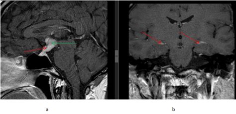 T1 brain MRI with gadolinium contrast, (a) sagittal plane showing ...