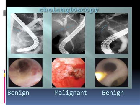 Biliary stricture ppt