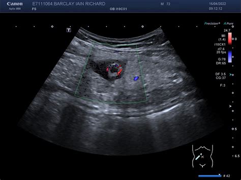 Laparoscopic repair of a Spigelian hernia with appendicitis in situ - Stanley - 2022 - ANZ ...