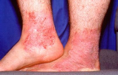 Foot Dermatoses