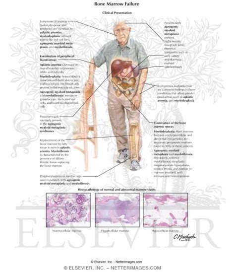 Bone Marrow Failure